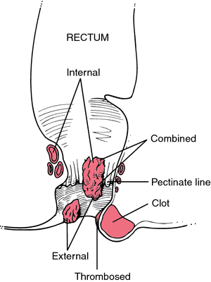 prolapsed hemorrhoid vs external