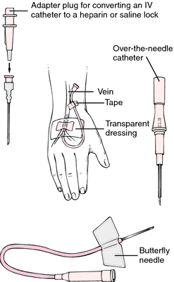 Heparin Lock Definition Of Heparin Lock By Medical Dictionary