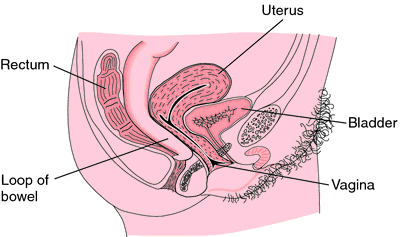 perineal hernia in women