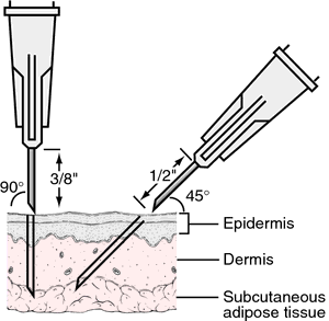 Injection (medicine) - Wikipedia