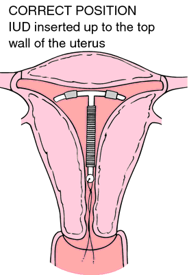 Copper Iud Definition Of Copper Iud By Medical Dictionary