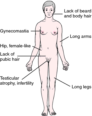 xxy chromosome female