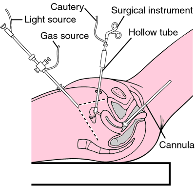 Laparotomy, Definition & Procedure