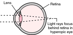 Design of Iseikonic Lenses, Part Two