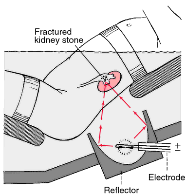 lithotripsy machine diagram