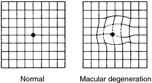 Macular Degeneration Line Chart