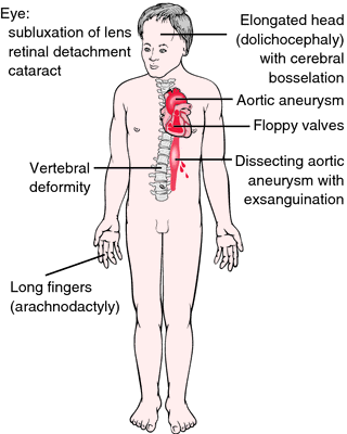 Finger length in Marfan syndrome - Mayo Clinic