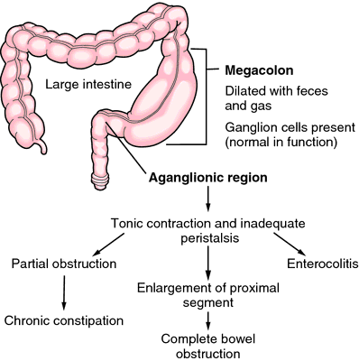 Toxic Megacolon Definition Of Toxic Megacolon By Medical Dictionary