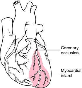 Myocardial Definition Of Myocardial By Medical Dictionary