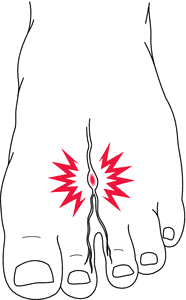 trigeminal neuralgia trigger points