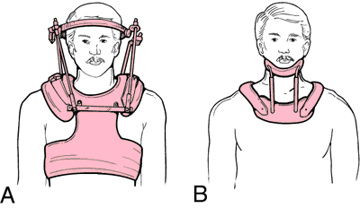 halo vest orthosis