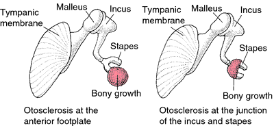 otosclerosis otoscopy