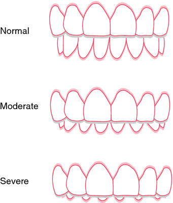 bad overbite teeth