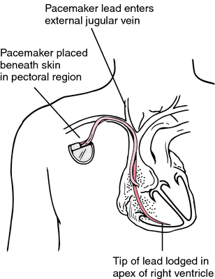 For temporary dummies pacemakers PACER &