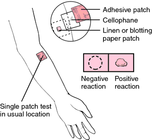 skin patch test