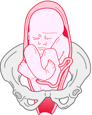 knee breech presentation