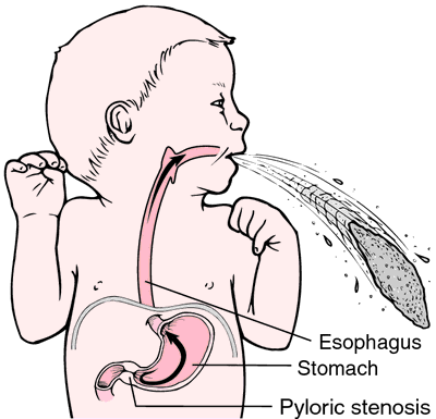 pyloric stenosis scar