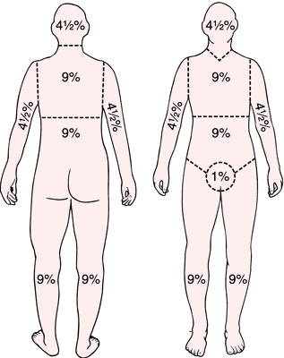 Burn Percentage Chart Rule Of 9