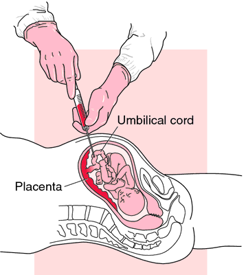 chorionic villi ultrasound