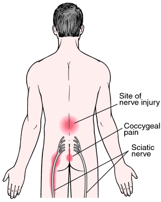 Sciatica - Wikipedia