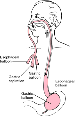 sengstaken blakemore tube inflation