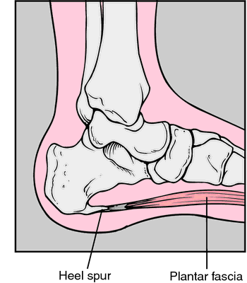 Spurring Definition Of Spurring By Medical Dictionary