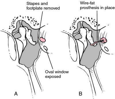 Stapedectomy of the Stapes of the Ear - Labelled – Medical Stock