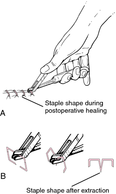 Meaning of clearance stapler