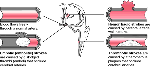 Hypertension Causes Hemorrhagic Stroke