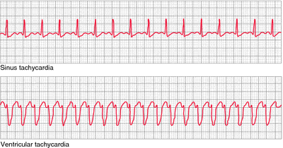 polymorphic ventricular tachycardia vs ventricular fibrillation