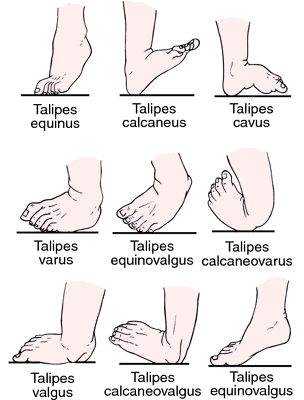 Talipes Definition Of Talipes By Medical Dictionary