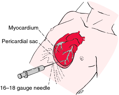 cardiac tamponade symptoms