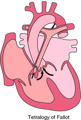 Tetralogy Of Fallot Definition Of Tetralogy Of Fallot By Medical Dictionary