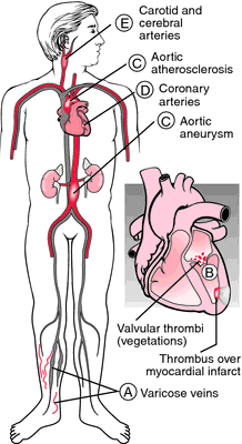 Mural Thrombus Definition Of Mural Thrombus By Medical Dictionary