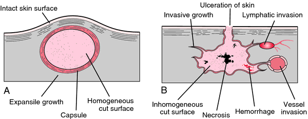 benign cancer growth