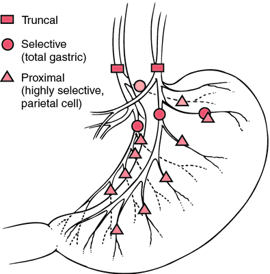 Truncal vagotomy | definition of truncal vagotomy by Medical dictionary