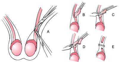 Vasectomy  definition of vasectomy by Medical dictionary