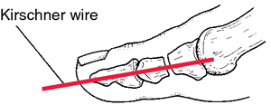 Arch wire definition of arch wire by Medical dictionary