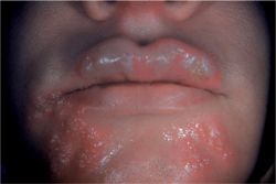 Herpes Simplex Definition Of Herpes Simplex By Medical Dictionary