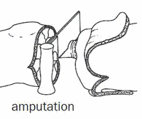 Amputation - definition of amputation by The Free Dictionary