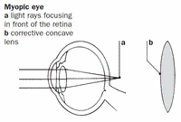 Myopia definition - You can find it in: