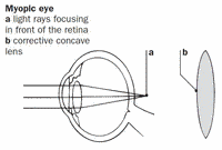 myopia definition of myopia)