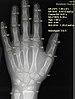 X-ray of hand, where bone age is automatically found by BoneXpert software.jpg