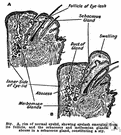 hordeolum - an infection of the sebaceous gland of the eyelid