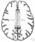 corpus callosum - a broad transverse nerve tract connecting the two cerebral hemispheres