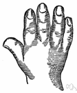 tumidity - slight swelling of an organ or part