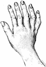 congenital abnormality - a defect that is present at birth