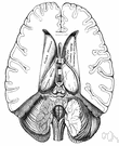 third ventricle - a narrow ventricle in the midplane below the corpus callosum