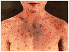 rubeola - an acute and highly contagious viral disease marked by distinct red spots followed by a rash
