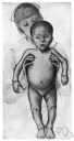 avitaminosis - any of several diseases caused by deficiency of one or more vitamins